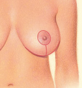 Around the areola, vertically down from the breast crease and horizontally along the breast crease